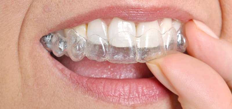 การจัดฟันแบบทั่วไปดีกว่าการจัดฟันแบบใสอินวิสไลน์(Invisalign)หรือไม่?​