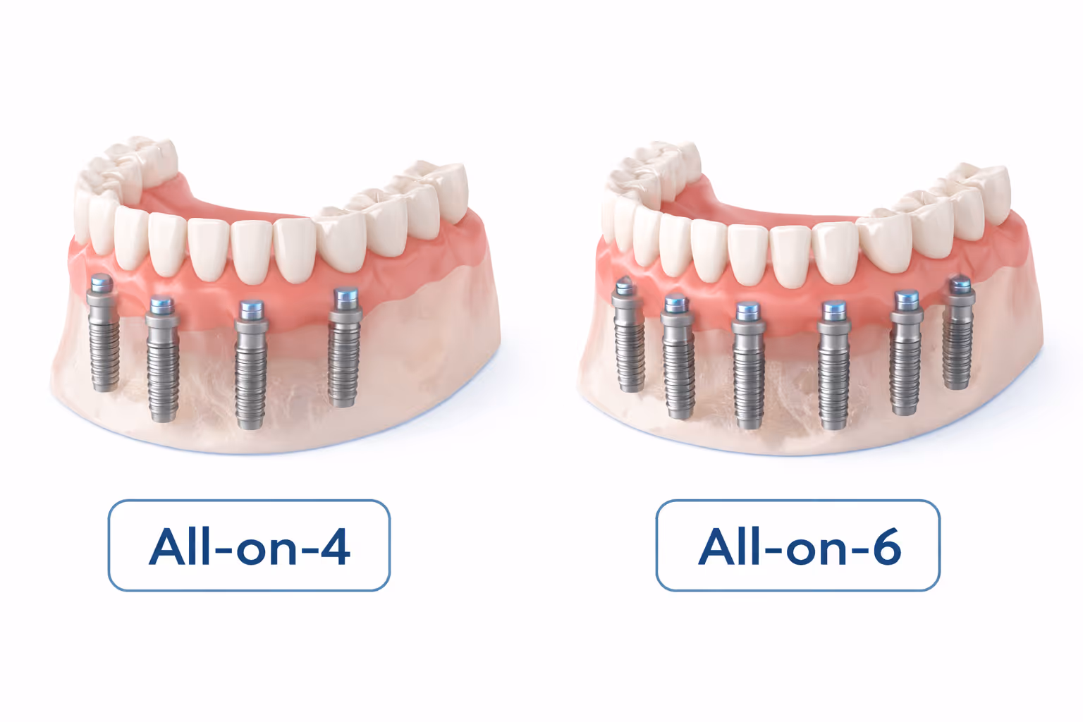 All-on-4 และ All-on-6 คืออะไร เหมาะกับใครบ้าง?