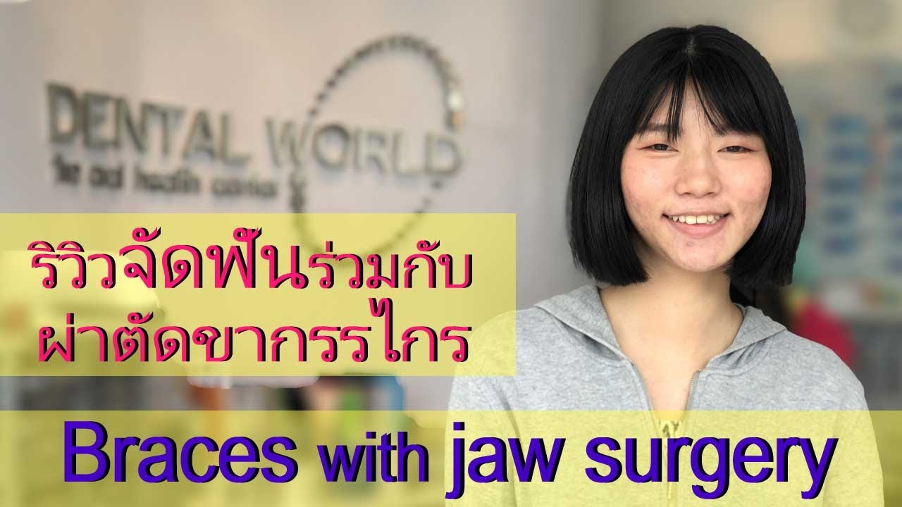 รีวิวจัดฟันร่วมกับผ่าตัดขากรรไกร | คลินิกทำฟัน เดนทัลเวิลด์ เชียงใหม่