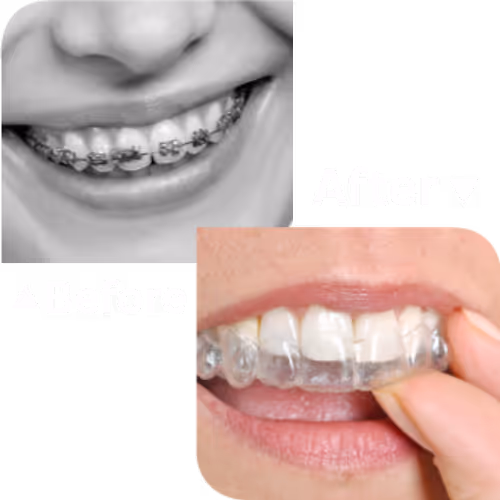 Invisalign จัดฟันแบบใส ไร้โลหะ | คลินิกทำฟัน เดนทัลเวิลด์ เชียงใหม่