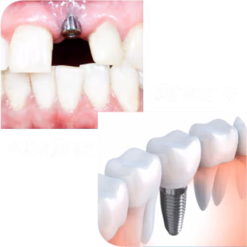 Dental Implant บริการทำรากฟันเทียม | คลินิกทำฟัน เดนทัลเวิลด์ เชียงใหม่
