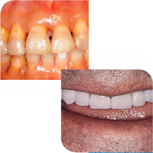 Dental Veneers บริการทำฟันวีเนียร์ | คลินิกทำฟัน เดนทัลเวิลด์ เชียงใหม่