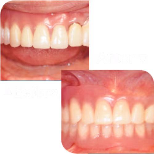Dental Dentures บริการทำฟันปลอม | คลินิกทำฟัน เดนทัลเวิลด์ เชียงใหม่