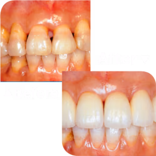 Ceramic Crowns บริการครอบฟันเซรามิค | คลินิกทำฟัน เดนทัลเวิลด์ เชียงใหม่