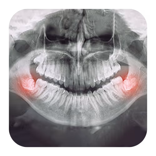 Wisdom Tooth Extraction บริการถอนฟัน/ผ่าฟันคุด | คลินิกทำฟัน เดนทัลเวิลด์ เชียงใหม่