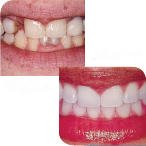 Dental Bridge บริการทำสะพานฟัน | คลินิกทำฟัน เดนทัลเวิลด์ เชียงใหม่