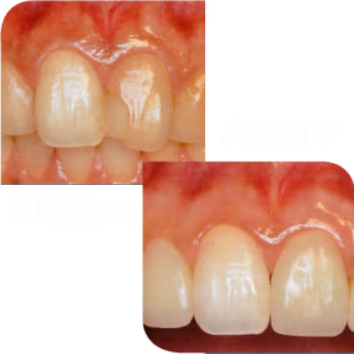 Tooth Whitening บริการฟอกสีฟัน | คลินิกทำฟัน เดนทัลเวิลด์ เชียงใหม่