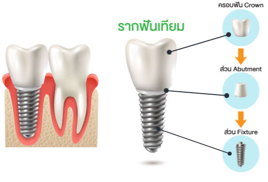 รากฟันเทียมประกอบด้วย 3 ส่วนคือ 