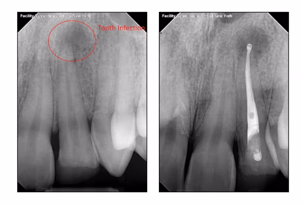Root Canal Treatment: Save Your Tooth, Save Your Smile | Dental World Chiang Mai