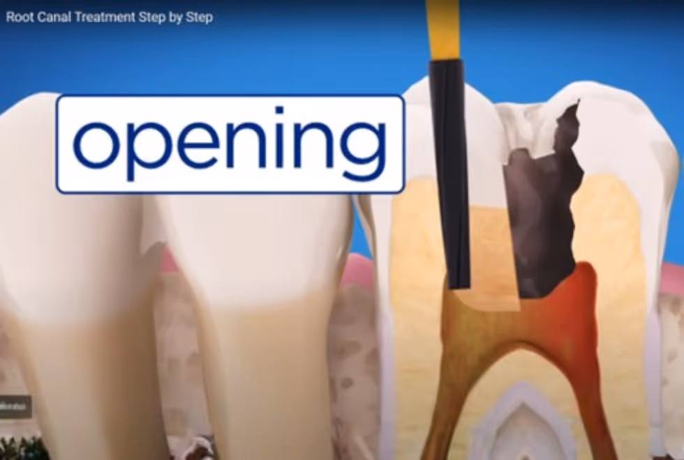 Root Canal Treatment: Save Your Tooth, Save Your Smile | Dental World Chiang Mai