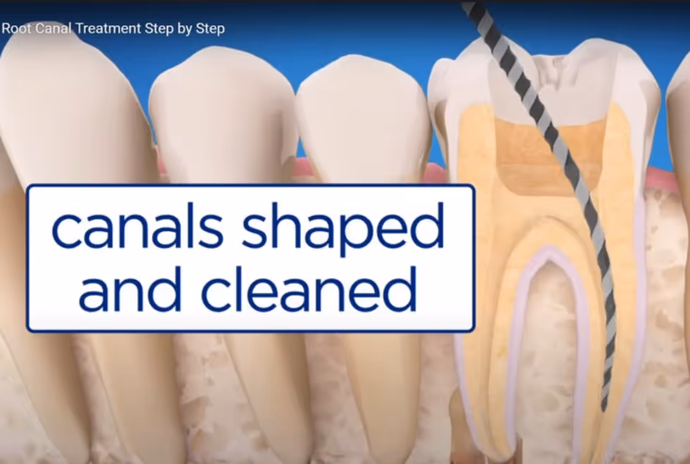 Root Canal Treatment: Save Your Tooth, Save Your Smile | Dental World Chiang Mai