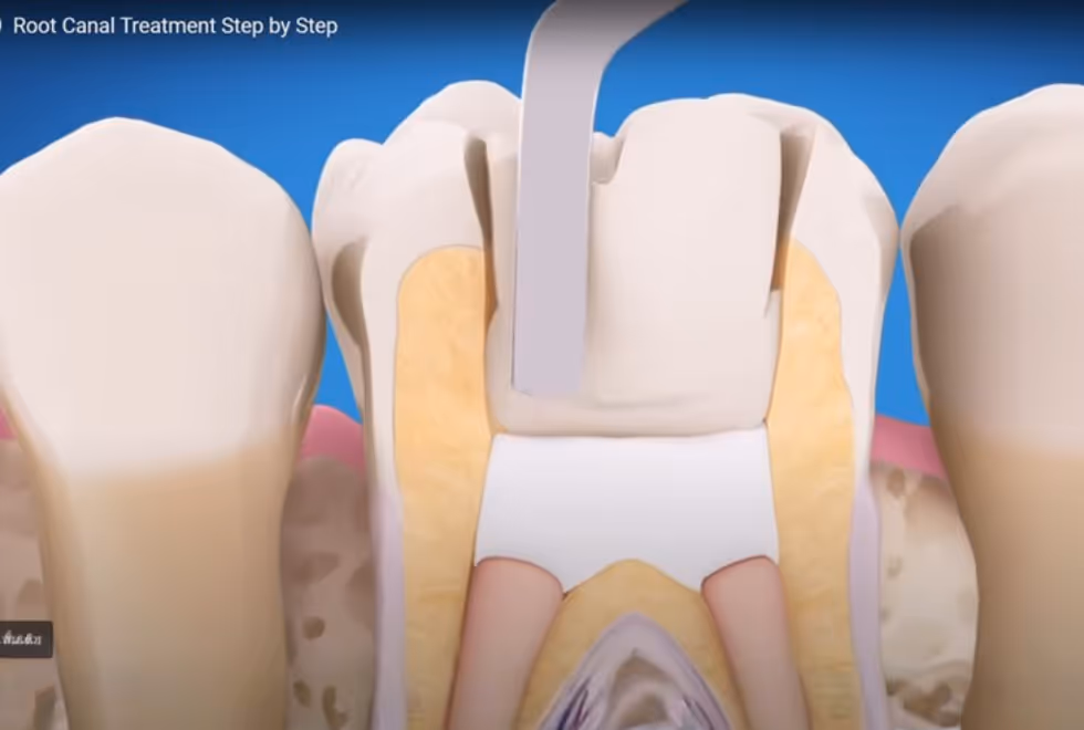 Root Canal Treatment: Save Your Tooth, Save Your Smile | Dental World Chiang Mai