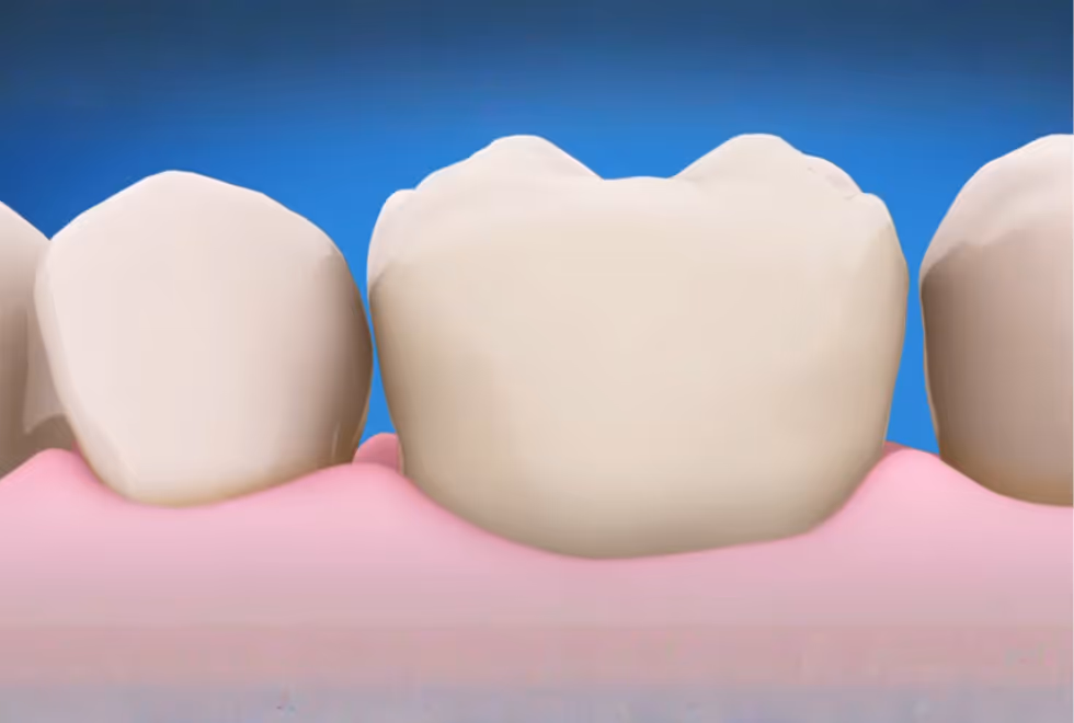 Root Canal Treatment: Save Your Tooth, Save Your Smile | Dental World Chiang Mai