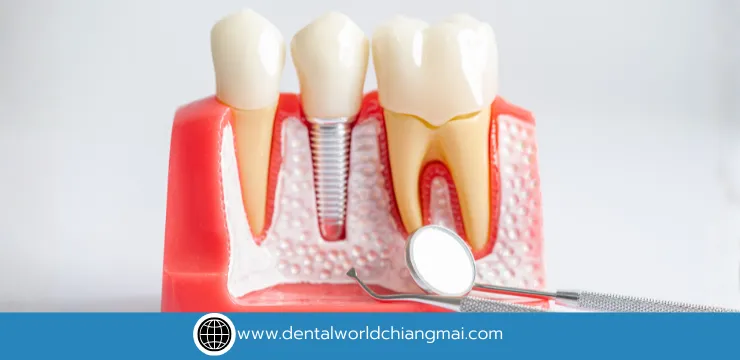 Root Canal Treatment: Save Your Tooth, Save Your Smile | Dental World Chiang Mai