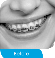 จัดฟันแบบใสไร้โลหะ (Invisalign)