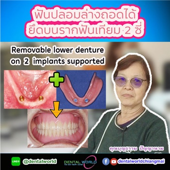 รีวิว คลินิกทำฟัน รักษารากฟัน จัดฟันแบบใส | เดนทัลเวิลด์เชียงใหม่
